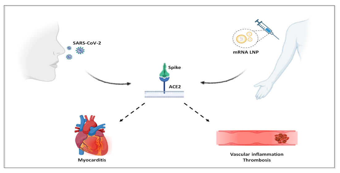 Expression du Protéine Spike de SARS-CoV-2 dans les Artères Cérébrales: Implications pour l’Accident Vasculaire Cérébral Hémorragique après la Vaccination par mRNA